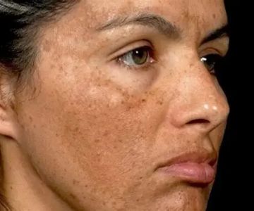How To Treat Your Dark Spots With These 10 Tips