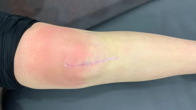 Expert Advice on Scars: Effective Treatments and Tips