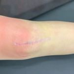 Expert Advice on Scars: Effective Treatments and Tips