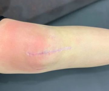 Expert Advice on Scars: Effective Treatments and Tips