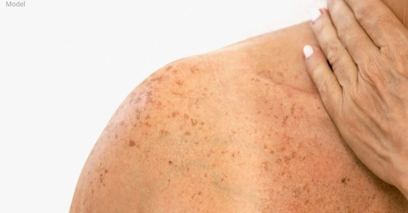 How To Choose The Right Sun Damage Treatment For People With Dry Skin