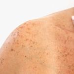 How To Choose The Right Sun Damage Treatment For People With Dry Skin