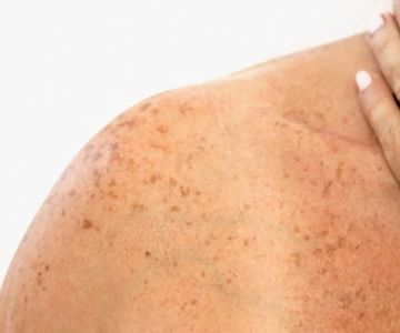 How To Choose The Right Sun Damage Treatment For People With Dry Skin