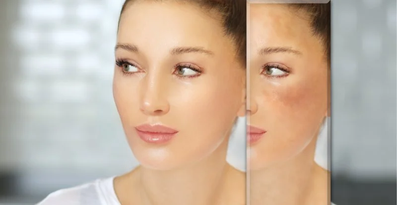 Best Ingredients for Rosacea and How to Manage It Effectively