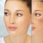 Best Ingredients for Rosacea and How to Manage It Effectively