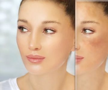 Best Ingredients for Rosacea and How to Manage It Effectively