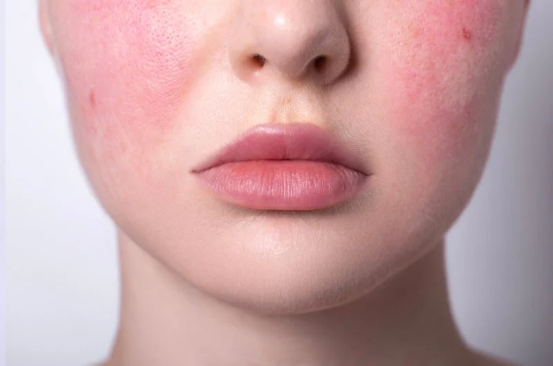 How to Manage Rosacea: Tips, Treatments, and Lifestyle Changes