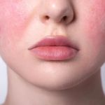 How to Manage Rosacea: Tips, Treatments, and Lifestyle Changes