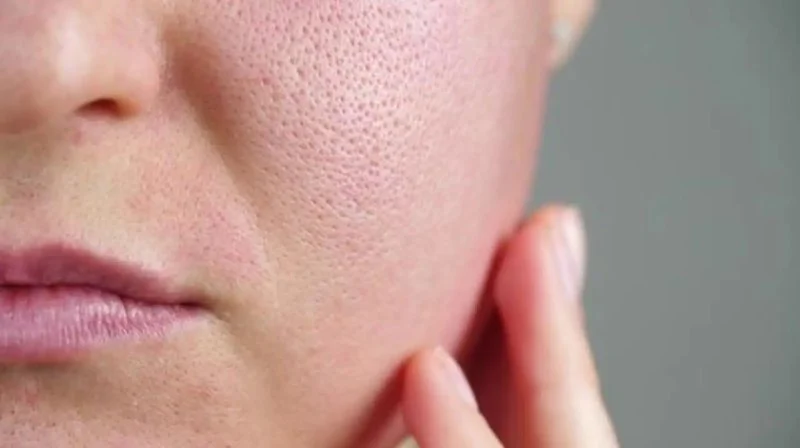 The Science Behind Large Pores and How to Manage It