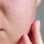 The Science Behind Large Pores and How to Manage It
