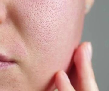 The Science Behind Large Pores and How to Manage It