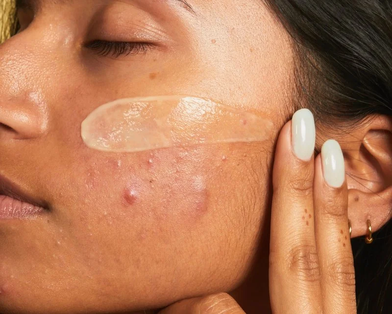 How to Avoid Inflamed Skin and Manage It Effectively