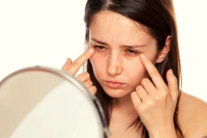 How to Deal with Dark Circles Using Natural Remedies