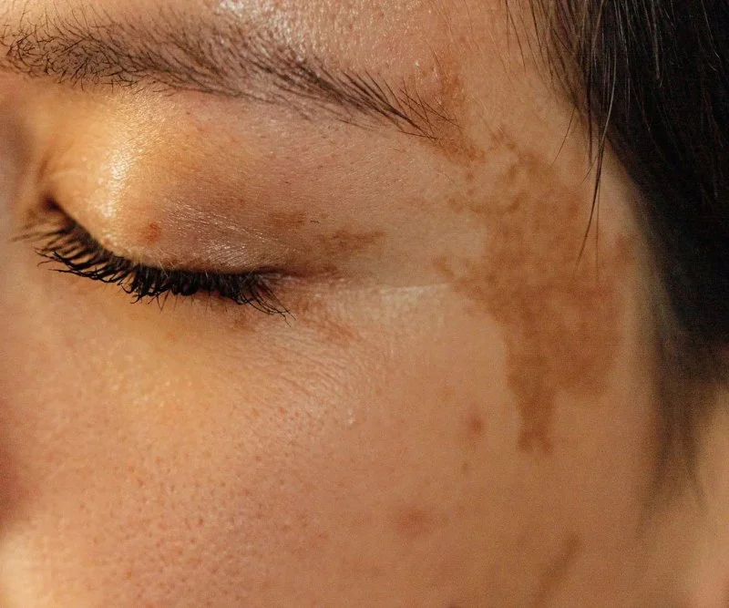 Understanding Hyperpigmentation Using Natural Remedies | SkinCare Experts