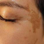 Understanding Hyperpigmentation Using Natural Remedies | SkinCare Experts