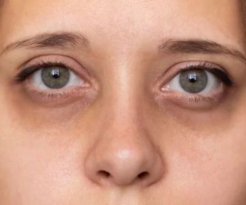 Daily Skin Care Routine for Dark Circles in People Living in Dry Climates