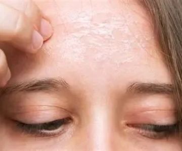 How to Avoid Retinol to Improve Age Spots: Natural Alternatives and Skincare Tips