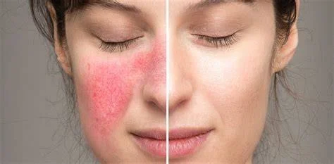 Guide to Skin Care Treatments for Rosacea for Women: Effective Solutions