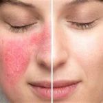 Guide to Skin Care Treatments for Rosacea for Women: Effective Solutions