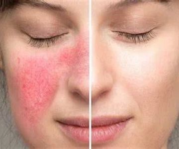 Guide to Skin Care Treatments for Rosacea for Women: Effective Solutions