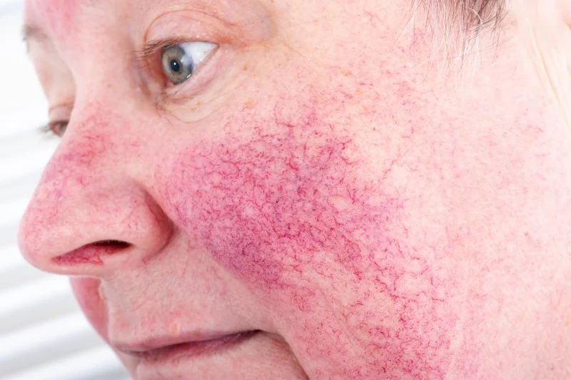 How to Repair Rosacea in People with Combination Skin