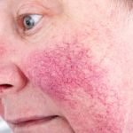 How to Repair Rosacea in People with Combination Skin
