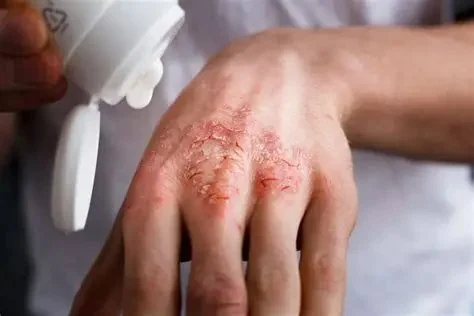 How to Heal Eczema Effectively: Top Tips and Treatments for Clearer Skin