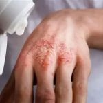 How to Heal Eczema Effectively: Top Tips and Treatments for Clearer Skin