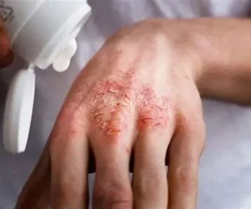 How to Heal Eczema Effectively: Top Tips and Treatments for Clearer Skin