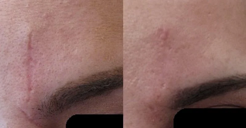 Best Practices for Scars Effectively: Tips and Treatments for Scar Reduction