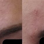 Best Practices for Scars Effectively: Tips and Treatments for Scar Reduction