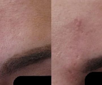 Best Practices for Scars Effectively: Tips and Treatments for Scar Reduction