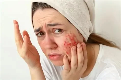 How to Avoid and Manage Inflamed Skin: Expert Skincare Advice