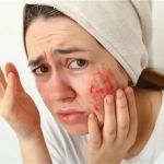 How to Avoid and Manage Inflamed Skin: Expert Skincare Advice