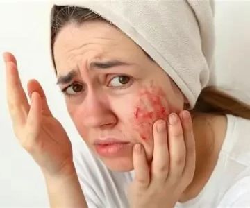 How to Avoid and Manage Inflamed Skin: Expert Skincare Advice