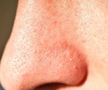 How To Heal Your Whiteheads With These 15 Tips