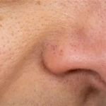 How to Manage Blackheads: Expert Tips for Clearer Skin