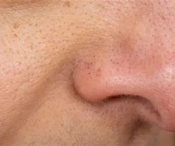 How to Manage Blackheads: Expert Tips for Clearer Skin