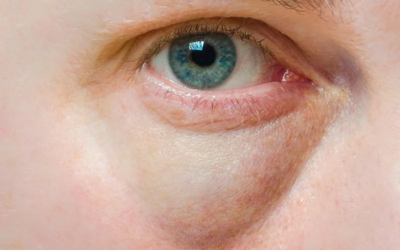 How To Achieve Puffy Eyes in Teens: Understanding Causes and Solutions