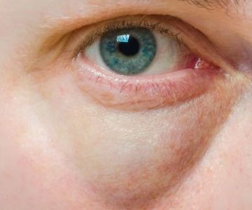 How To Achieve Puffy Eyes in Teens: Understanding Causes and Solutions
