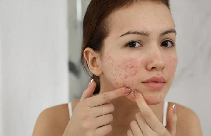 How to Manage Inflamed Skin for People with Combination Skin – Expert Tips