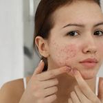 How to Manage Inflamed Skin for People with Combination Skin – Expert Tips