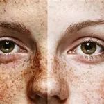 How To Heal Sun Damage And How To Manage It