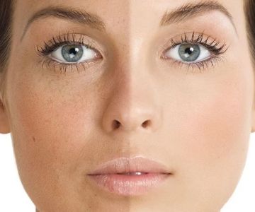Skin Care Tips for Uneven Skin Tone With A Simple Routine