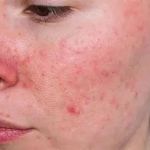 Benefits of Using Rosacea With a Simple Routine: A Guide for Clearer Skin