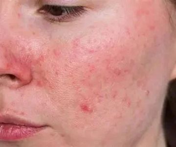 Benefits of Using Rosacea With a Simple Routine: A Guide for Clearer Skin