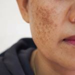 How to Choose the Right Sun Damage Treatments for People with Dry Skin