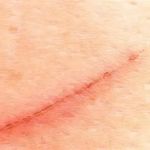 How To Prevent Scars With A Simple Routine
