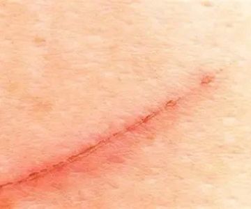 How To Prevent Scars With A Simple Routine