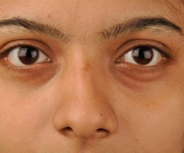 Expert Advice on Puffy Eyes with a Simple Routine | Effective Eye Care Tips